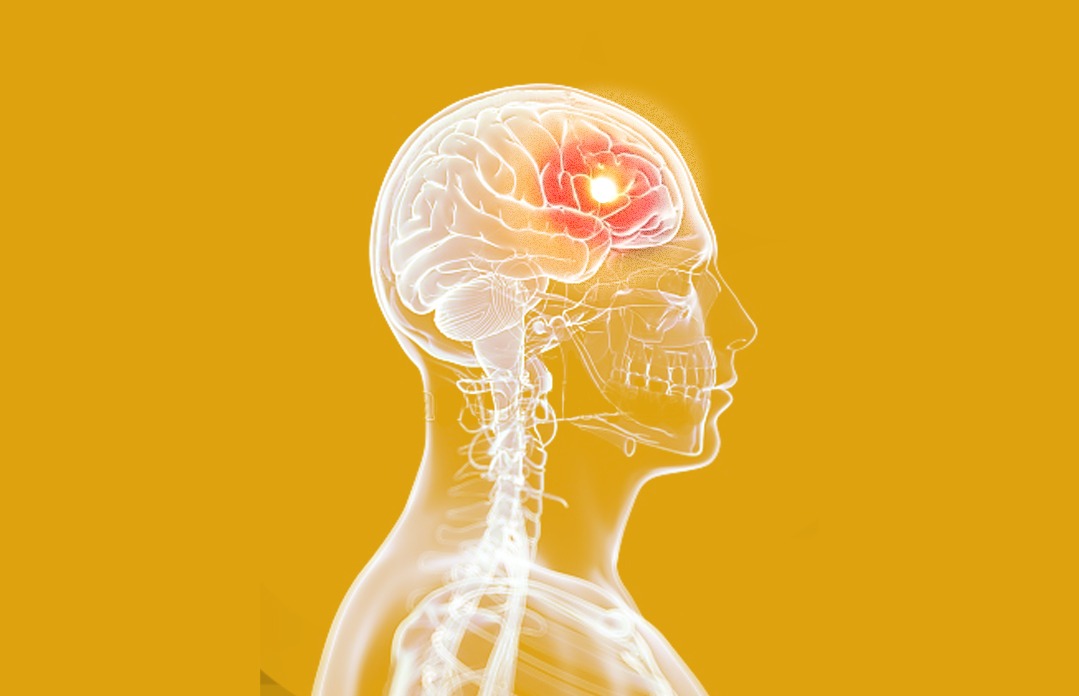 Heme como indutor de dano cerebral no AVC hemorrágico: potenciais implicações terapêuticas